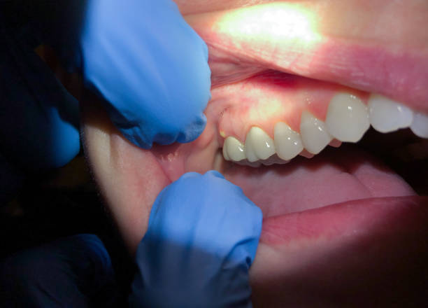 Best Emergency Wisdom Teeth Removal in Aquebogue, NY